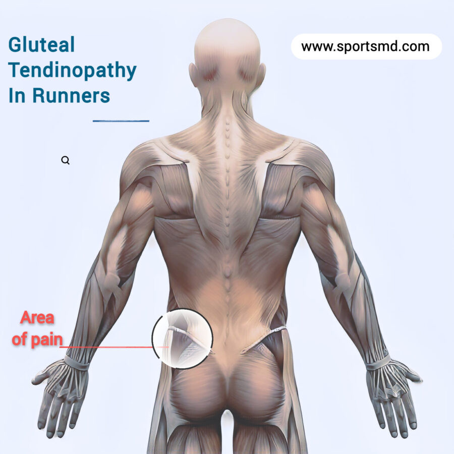 Outer Hip Pain RunnersMD