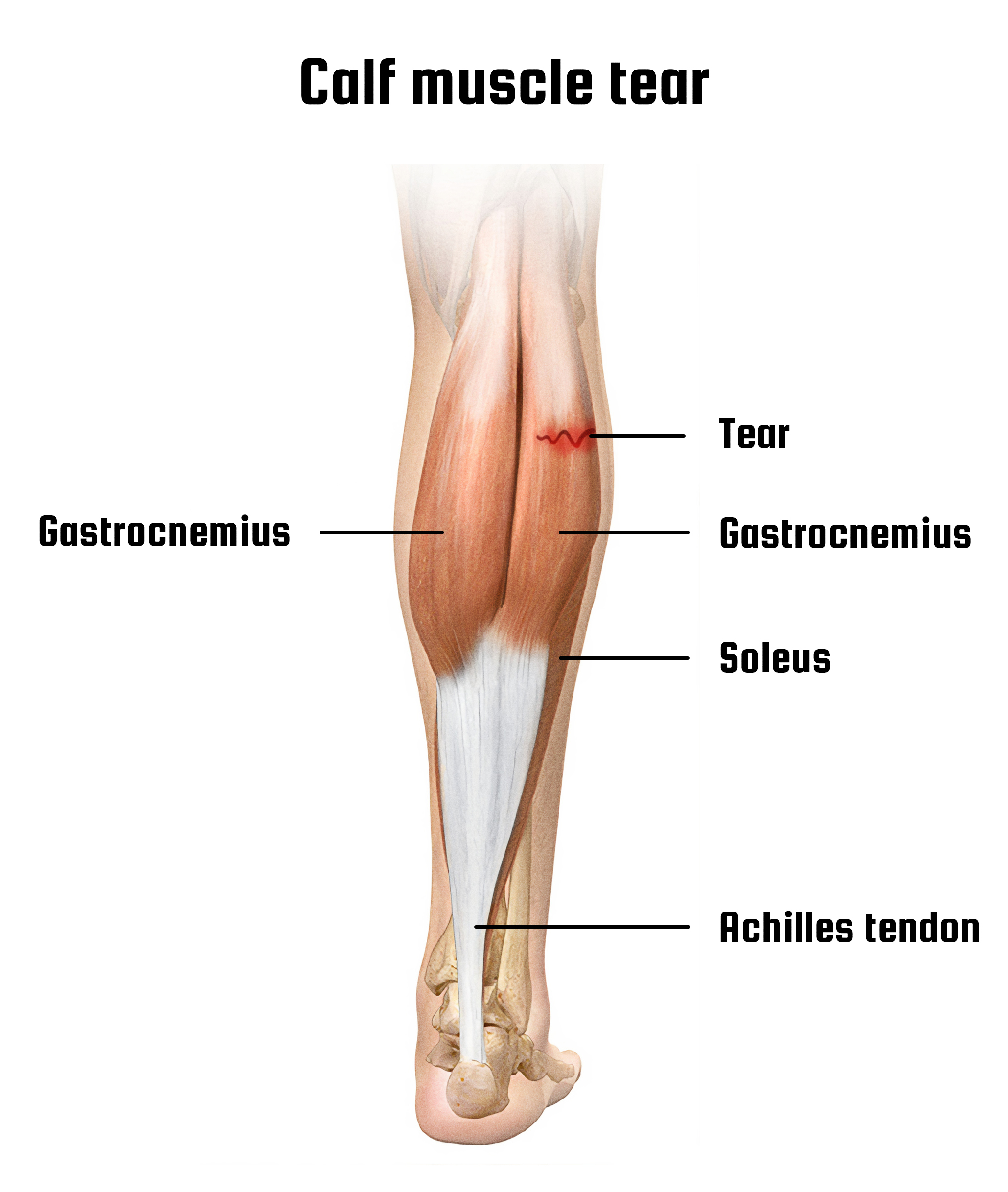 Calf Strain Treatment and Recovery RunnersMD