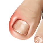 ingrown toenail infection