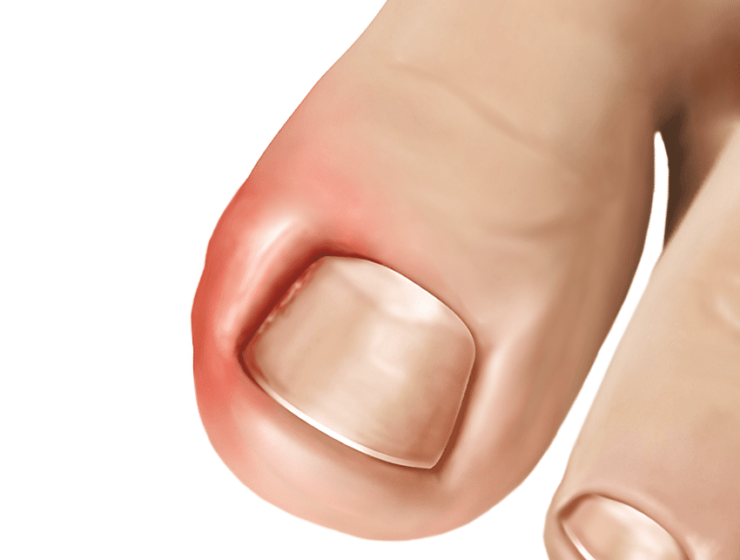 ingrown toenail infection