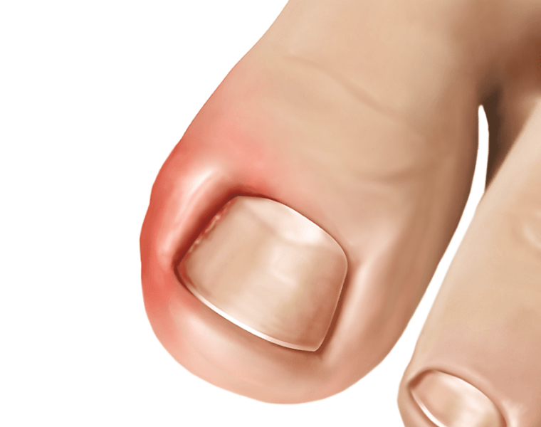 ingrown toenail infection