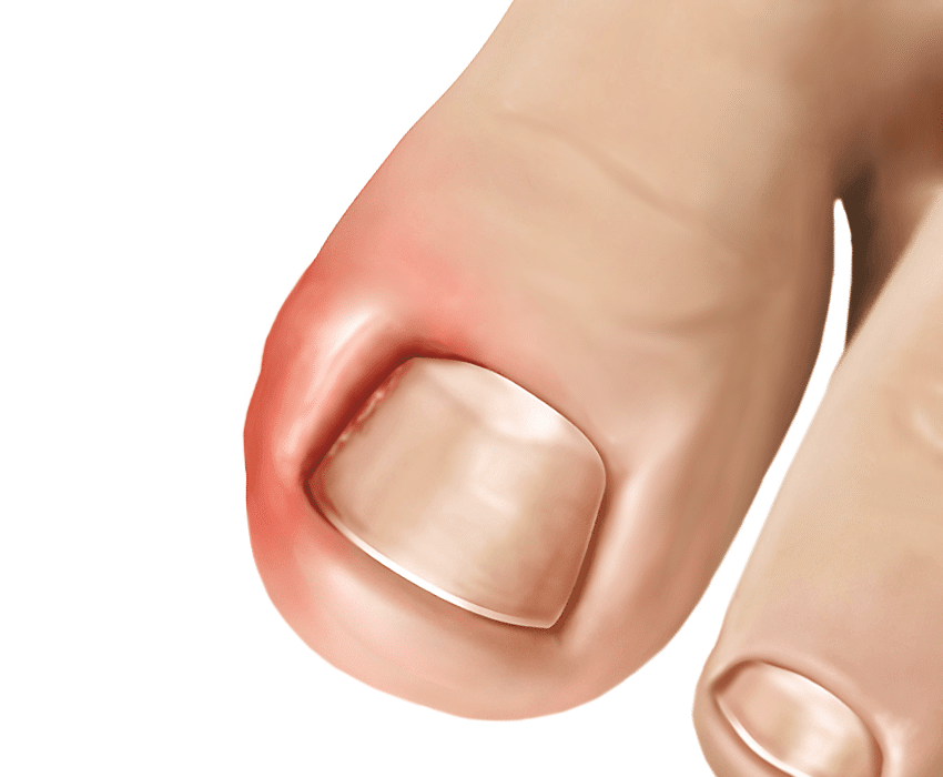 ingrown toenail infection