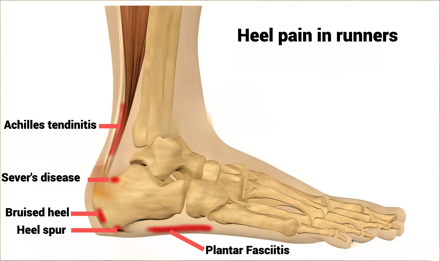 Heel Pain RunnersMD Heel Pain RunnersMD
